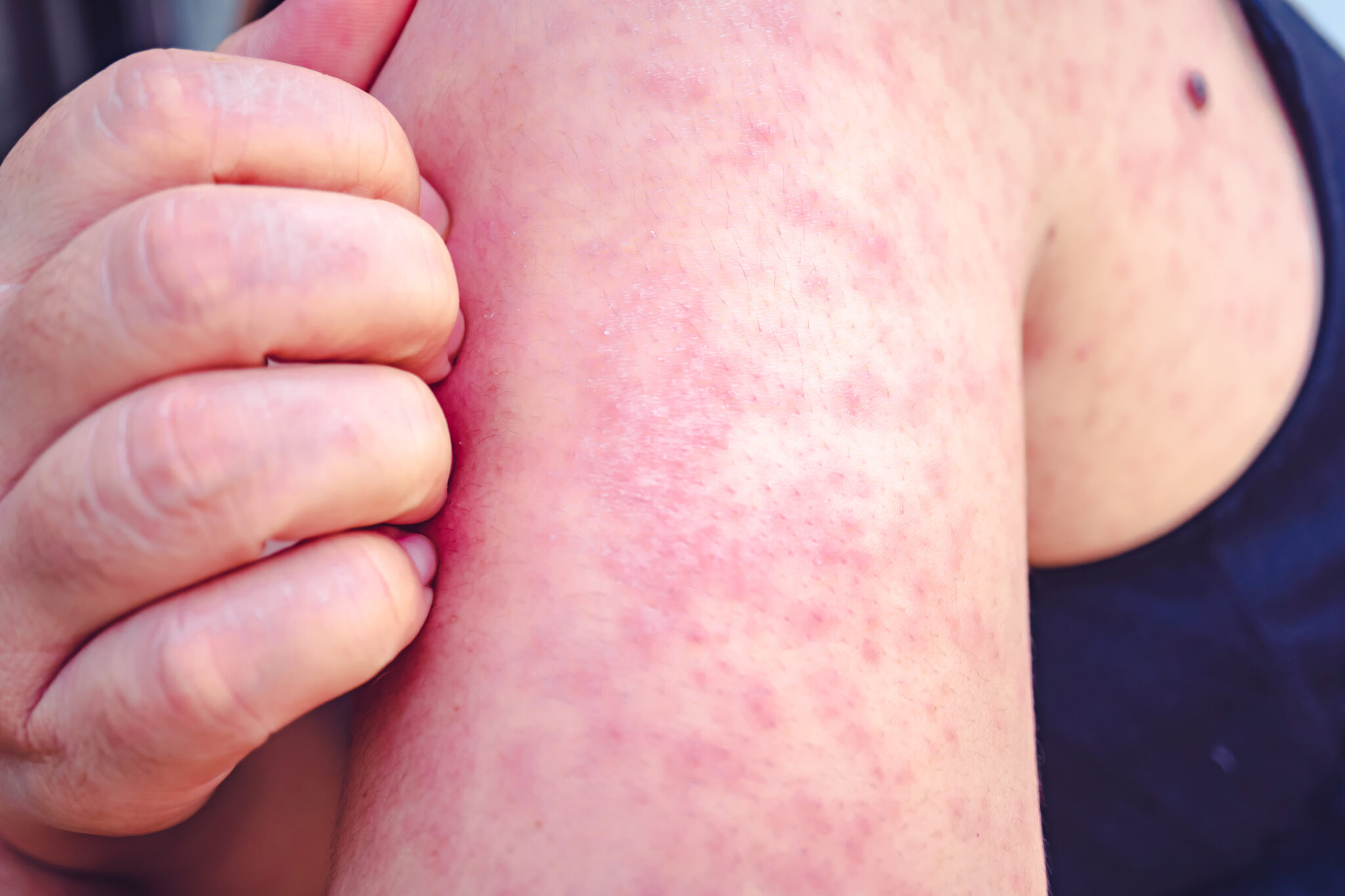 Child traveling through KY in March had measles but no one else was exposed, says state
