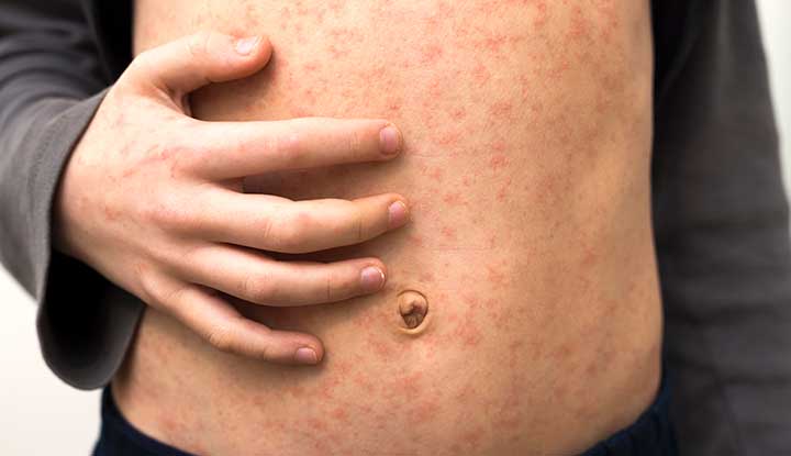 2nd case of measles confirmed; Kindergarten vaccine rates drop; Study, measles could become endemic again