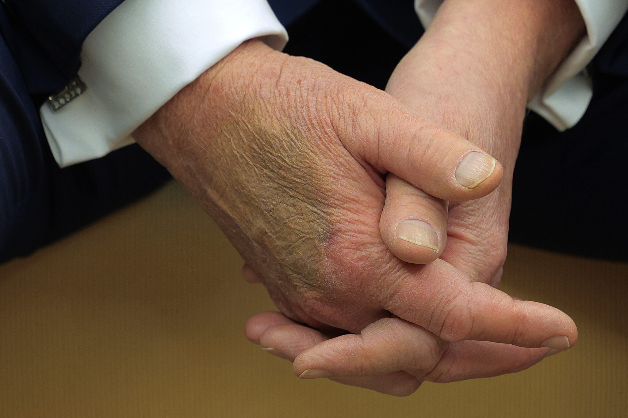 Trump, 79, has ‘benign’ vein condition; bruised hand blamed on handshaking, aspirin